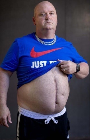 LSS Participant Daniel Woolley lifts his shirt to show scars from his motor vehicle injury.